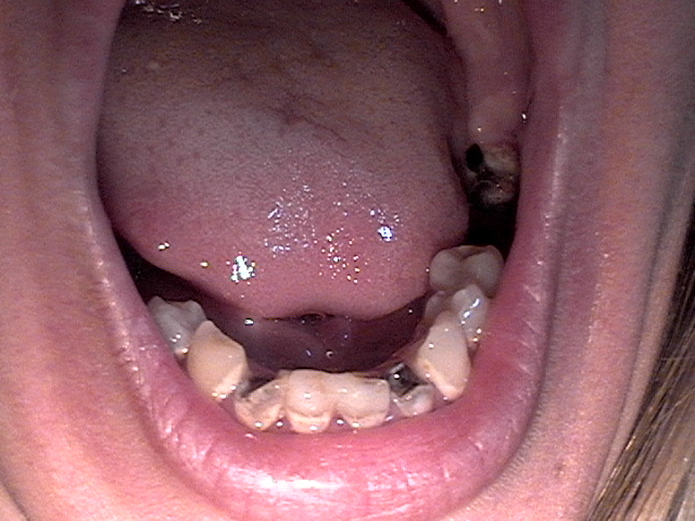 bottom teeth
