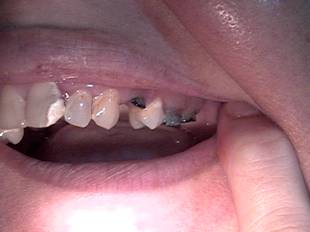other side view top teeth