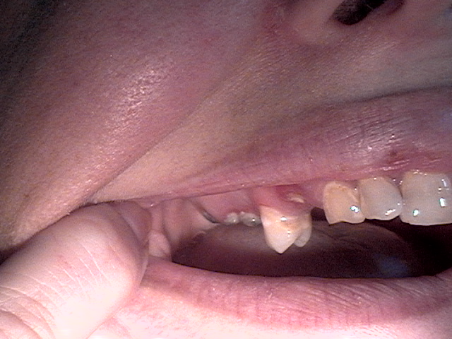 side view top teeth