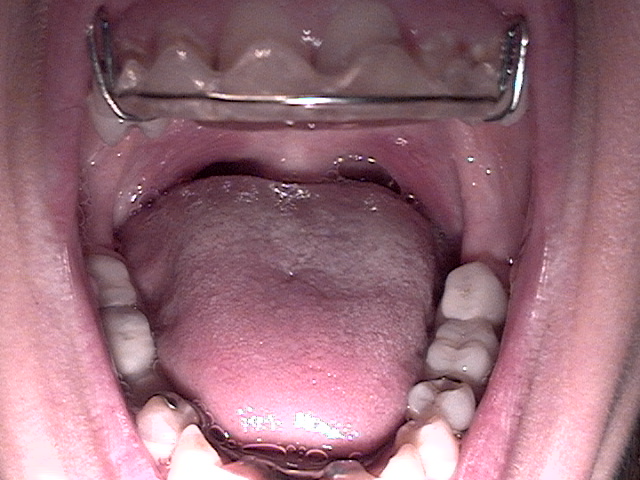 partialbackteeth.jpg